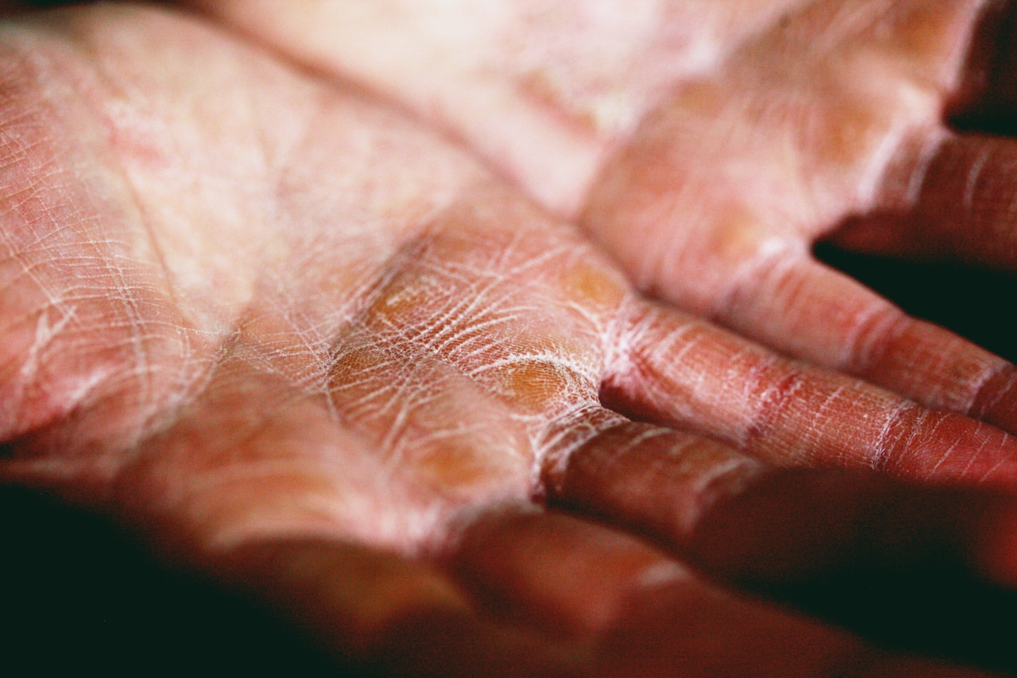 Dry skin on palms.